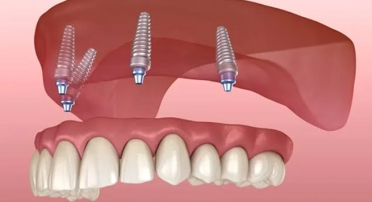 What Are All-On-4 Dental Implants and In Which Situations Are They Preferred?