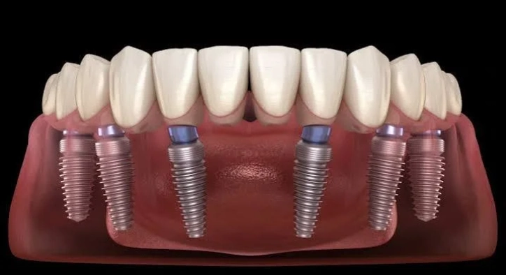 In Which Cases Are All-On-6 Dental Implants Performed? Results, Reviews and Prices