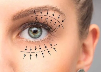 Was Ist Eine Blepharoplastik? Wie Wird Der Eingriff Durchgeführt?