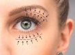 What Is Blepharoplasty? How Is the Surgery Performed?