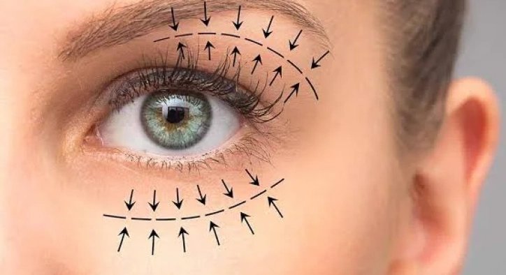 What Is Blepharoplasty? How Is the Surgery Performed?