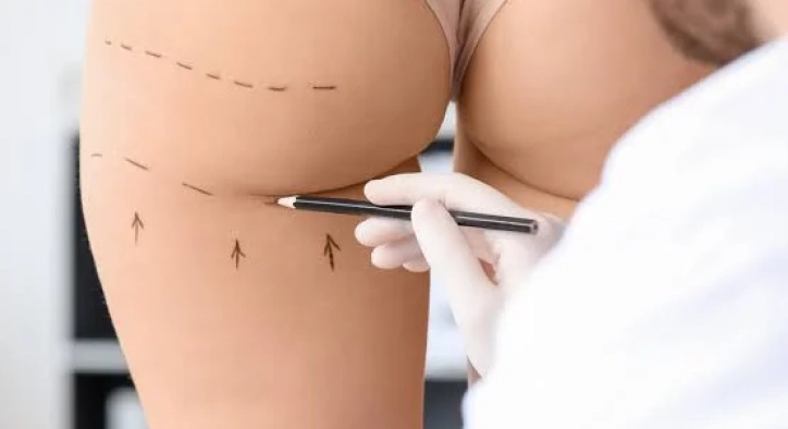 What Is Brazilian Butt Lift? Turkey Costs, Safety & Results