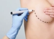 How Is Breast Augmentation Performed? Recovery Process, Results and Prices