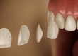 E-Max-Veneers Ablauf, Kosten & Haltbarkeit in der Türkei