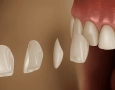 E-Max-Veneers Ablauf, Kosten & Haltbarkeit in der Türkei