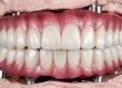 How Are Full-Mouth Dental Implants Performed? Prices in Turkey