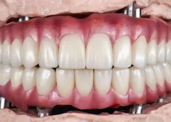How Are Full-Mouth Dental Implants Performed? Prices in Turkey