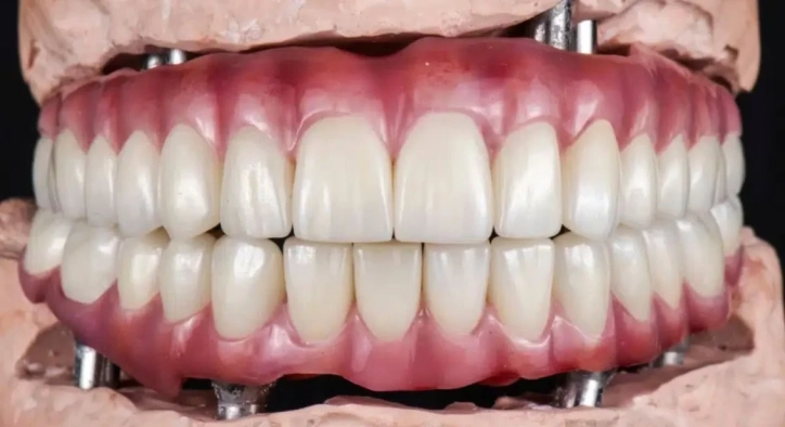 How Are Full-Mouth Dental Implants Performed? Prices in Turkey