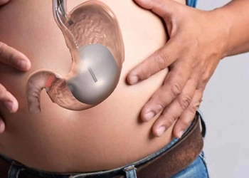 What Is Gastric Balloon? Turkey Costs, Procedures & Results