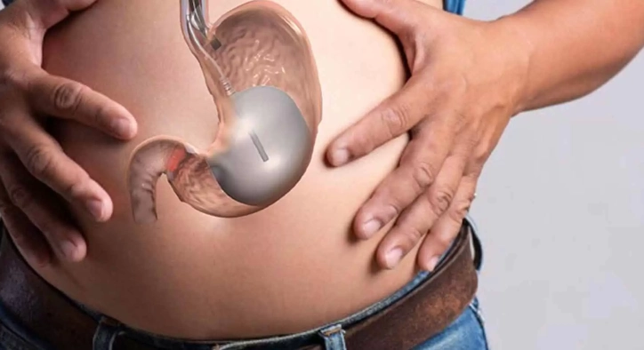 What Is Gastric Balloon? Turkey Costs, Procedures & Results