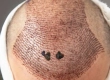 Nekrose nach Haartransplantation: Symptome & Behandlung