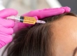Was Ist eine Stammzellen-Haartransplantation? Ablauf und Preise