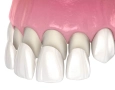 Verfahren zum Austausch von Veneers, Haltbarkeit und Kosten