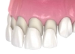 Veneer Replacement Procedures, Longevity & Costs