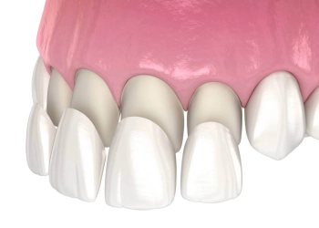 Veneer Replacement Procedures, Longevity & Costs