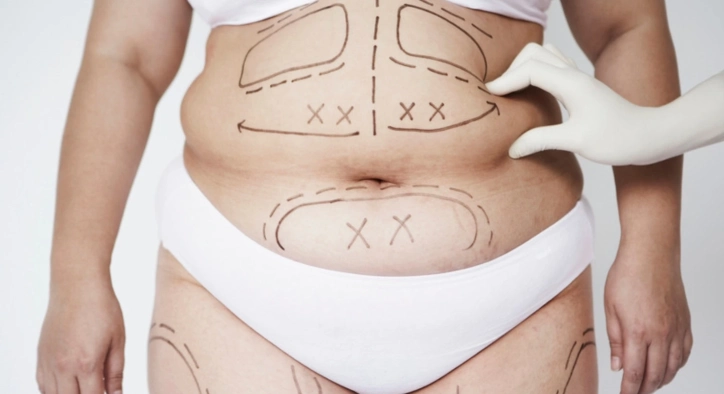 Wie wird die 360-Vaser-Liposuktion durchgeführt? Kosten, Ergebnisse und Erfahrungsberichte