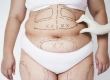 How Is 360 Vaser Liposuction Performed? Costs, Results and Reviews