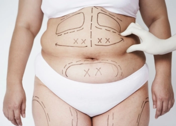 How Is 360 Vaser Liposuction Performed? Costs, Results and Reviews