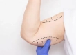 How Is Arm Lift Surgery Performed? Do Arm Lift Scars Stay Visible?
