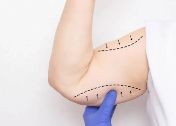 How Is Arm Lift Surgery Performed? Do Arm Lift Scars Stay Visible?