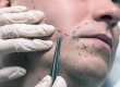 Beard Transplant: Turkey Costs, DHI Techniques & Results