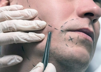 Beard Transplant: Turkey Costs, DHI Techniques & Results