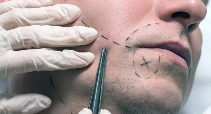 Beard Transplant: Turkey Costs, DHI Techniques & Results