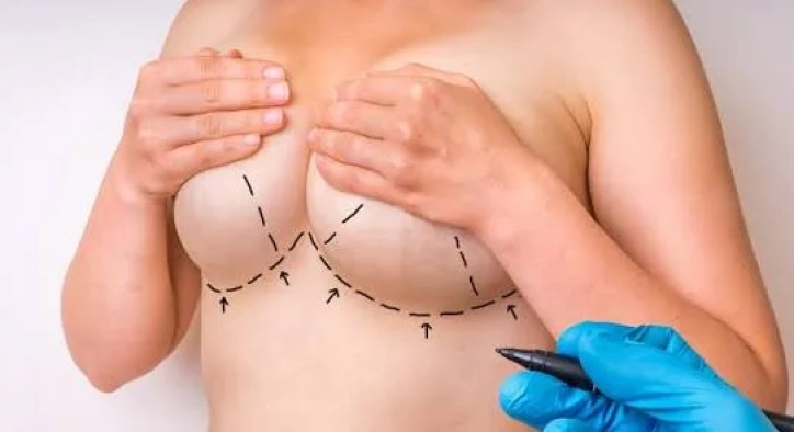 Breast Augmentation with Fat Transfer: Costs & Results