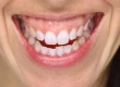 Gummy Smile: Botox, Gingivektomie & Behandlung