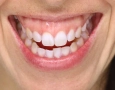 Gummy Smile: Botox, Gingivektomie & Behandlung