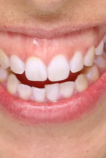 Gummy Smile: Botox, Gingivektomie & Behandlung