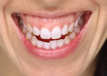 Gummy Smile: Botox, Gingivektomie & Behandlung