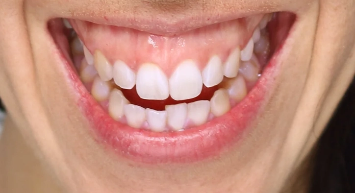 Gummy Smile: Botox, Gingivektomie & Behandlung