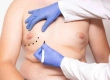 Gynecomastia Surgery: Turkey Costs, Results & Surgery Guide