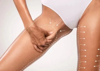 Thigh Lift Surgery: Turkey Costs, Recovery & Scars Guide
