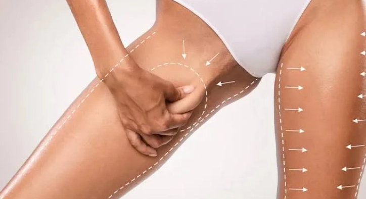 Thigh Lift Surgery: Turkey Costs, Recovery & Scars Guide