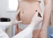 How Is a Tummy Tuck Performed? Costs and Recovery Process