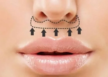 Bullhorn-Lippenlifting in der Türkei: Kosten, OP & Narben