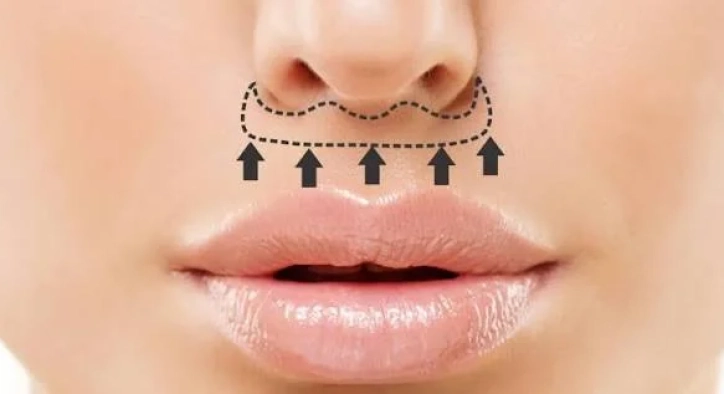 Bullhorn Lip Lift: Turkey Costs, Scars & Recovery Guide