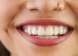 Clear Aligners: Turkey Costs, Braces vs Aligners & Care