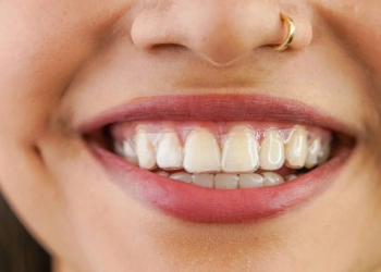 Clear Aligners: Turkey Costs, Braces vs Aligners & Care