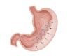 Endoscopic Sleeve Gastroplasty: Turkey Costs & Results