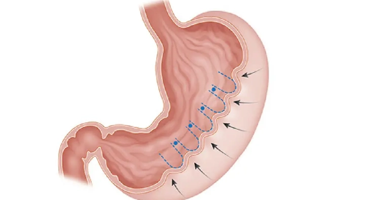 Endoscopic Sleeve Gastroplasty: Turkey Costs & Results