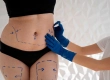 Gastric Botox: Turkey Costs, Reviews & Procedure Guide