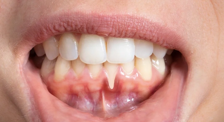 Gum Graft Surgery: Turkey Costs, Root Coverage & Healing