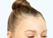 Hairline Lowering: Turkey Costs, Surgical vs FUE Guide
