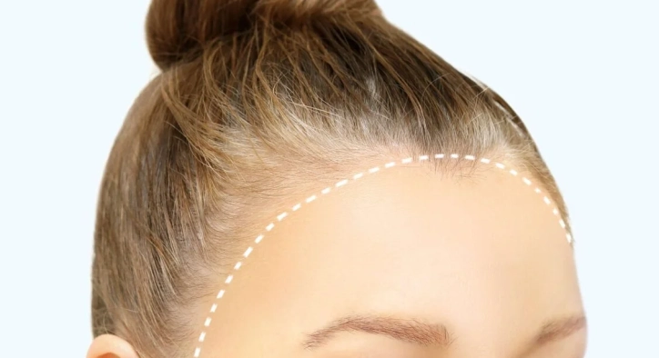 Hairline Lowering: Turkey Costs, Surgical vs FUE Guide