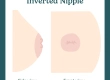 Inverted Nipple Surgery: Turkey Costs, Correction & Safety