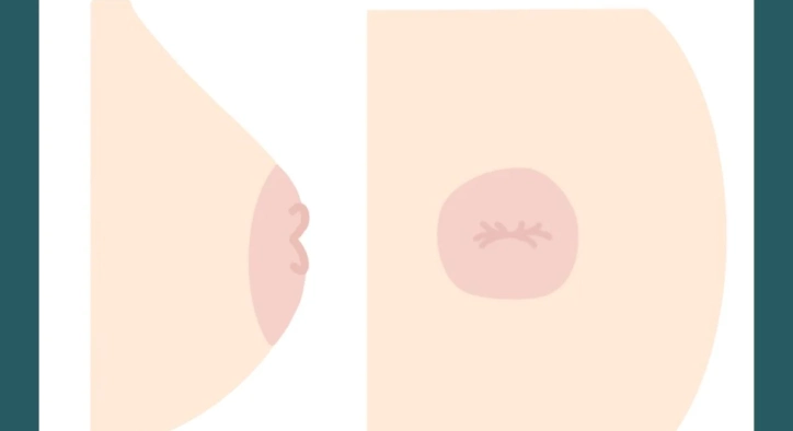 Inverted Nipple Surgery: Turkey Costs, Correction & Safety