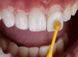 Keramik-Veneers in der Türkei: Kosten, Haltbarkeit & E-Max